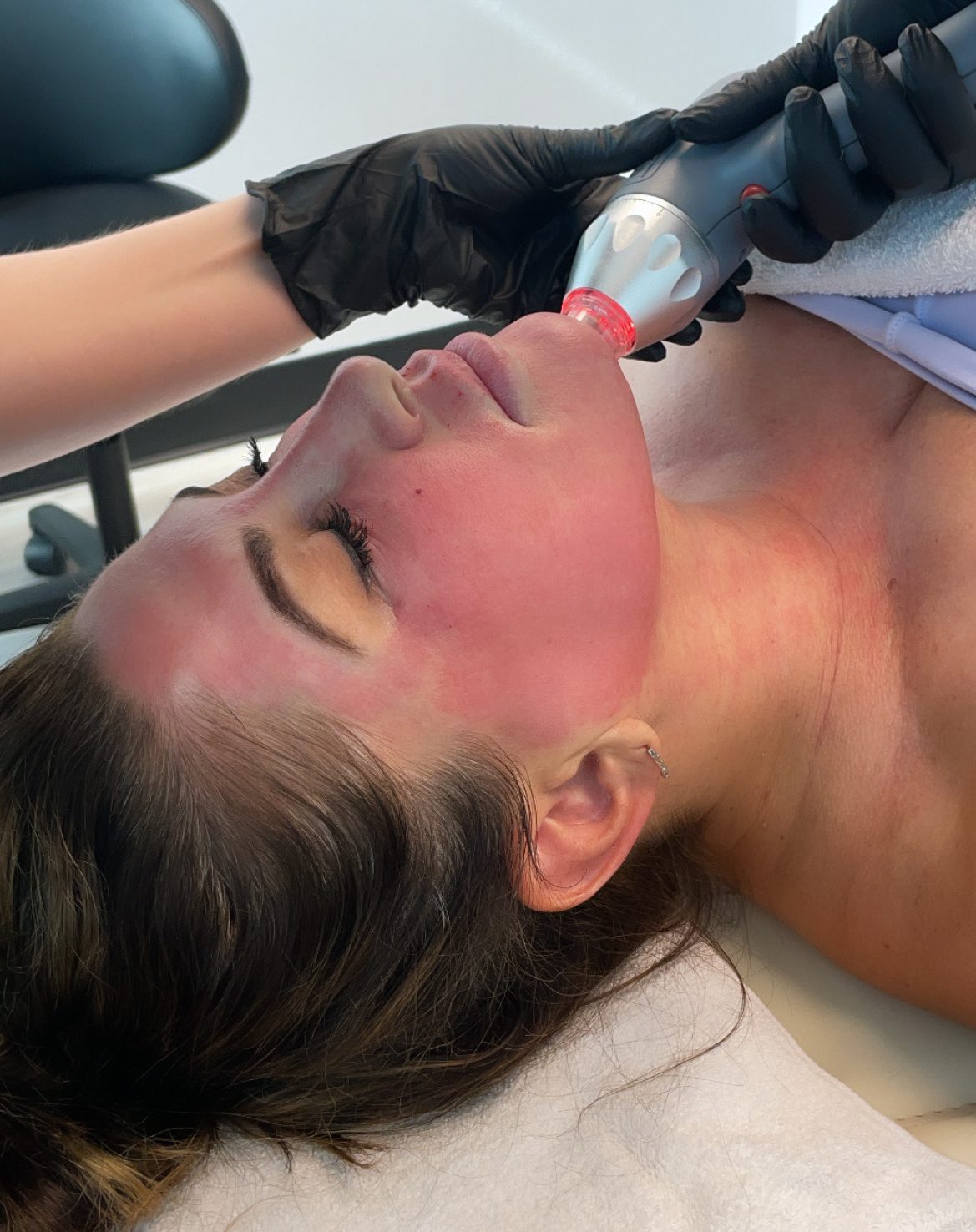 Jacqueline Laurita receiving the RF Microneedling treatment on her face, neck and chest to tighten the skin.