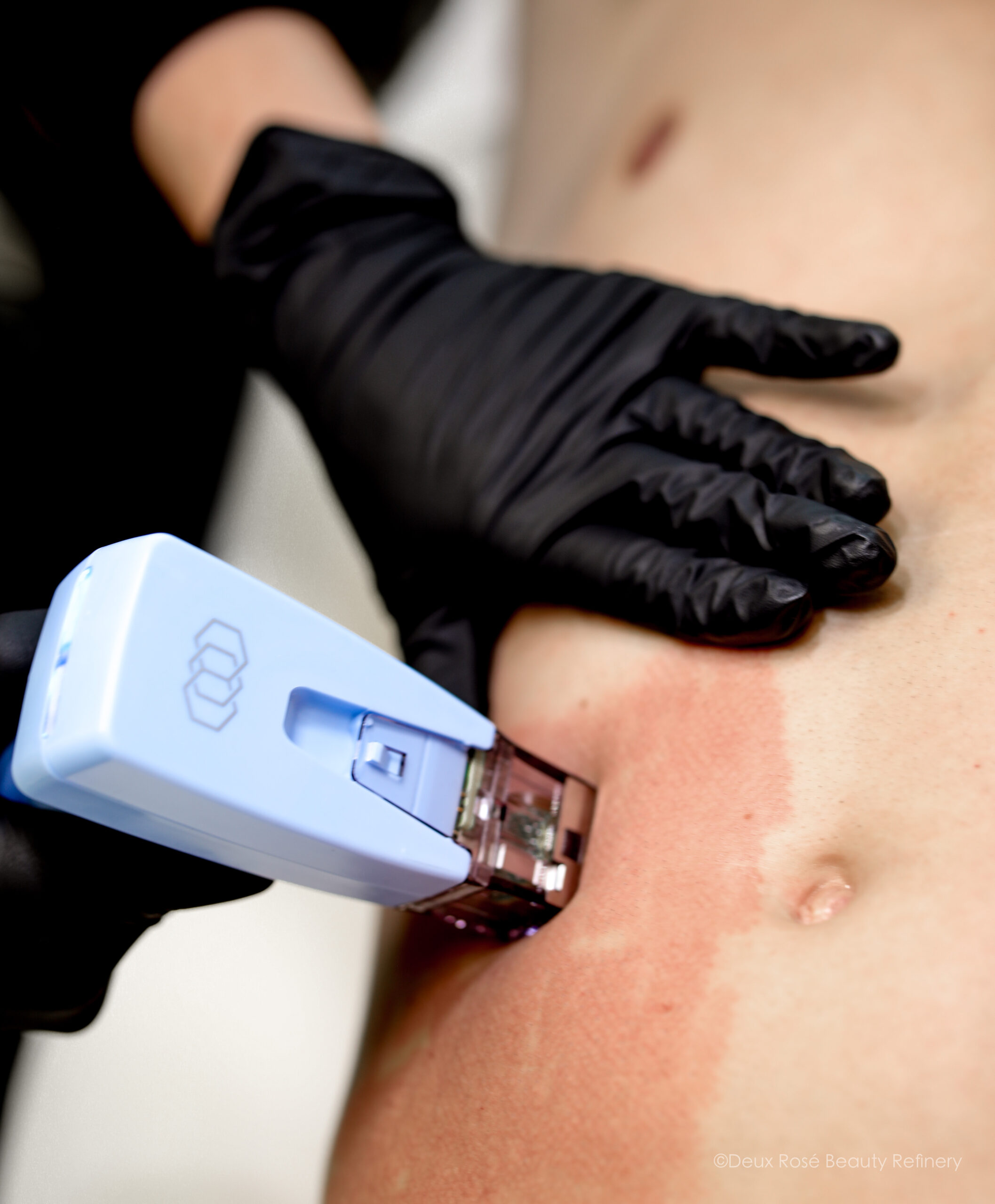 Kim Kardashian’s Skin Tightening Secret