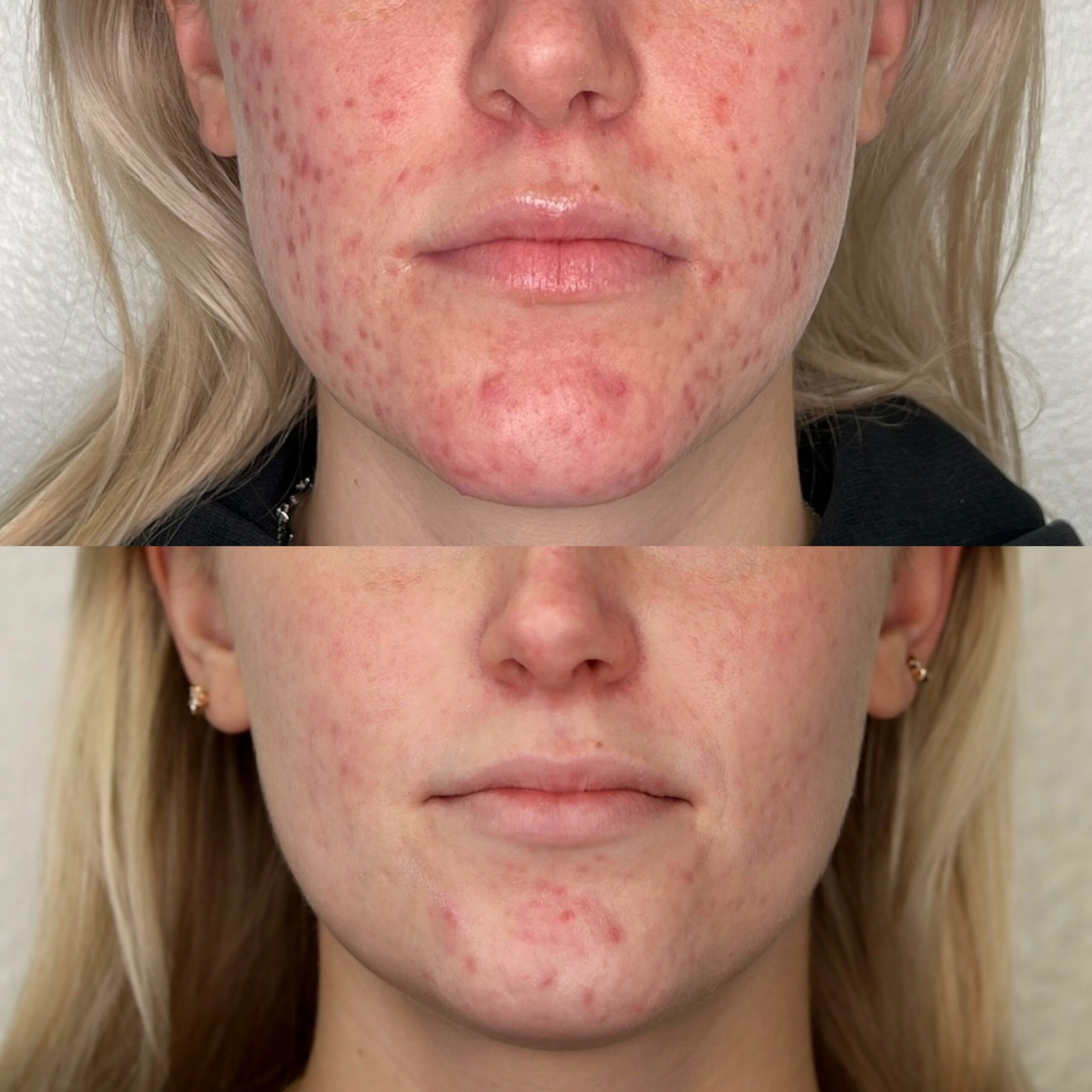 Transform Your Skin: The Benefits of SkinPen Microneedling Explained